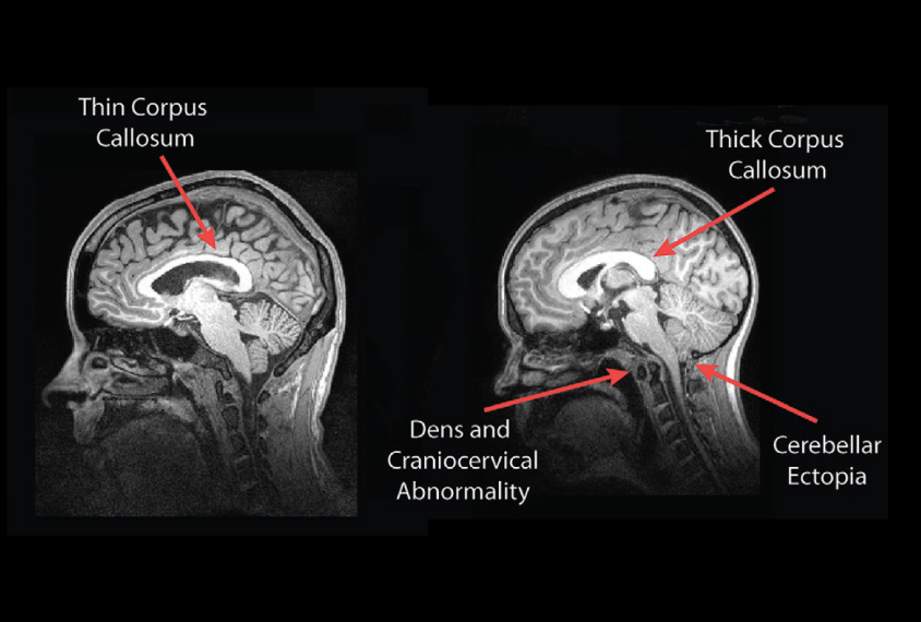 The thickness of the corpus callosum tends to differ in people with a deletion (right) or duplication (left) of the chromosomal region 16p11.2.