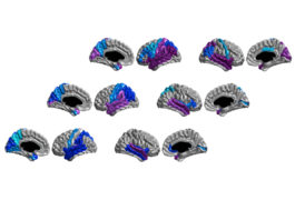 Structural anomalies (purple and blue) in the brains of babies with autism at 6 months (bottom row) become more widespread by 12 months (top row).