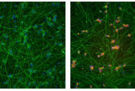 Deleting DNA repeats from fragile X neurons restores expression (right, red) of the gene silenced in the syndrome.