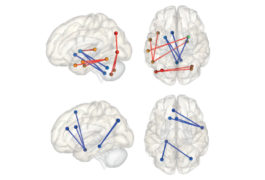 Relative to controls, children with autism taking certain drugs have greater functional connectivity between brain regions (top, red), whereas unmedicated children with autism show less connectivity (bottom, blue).