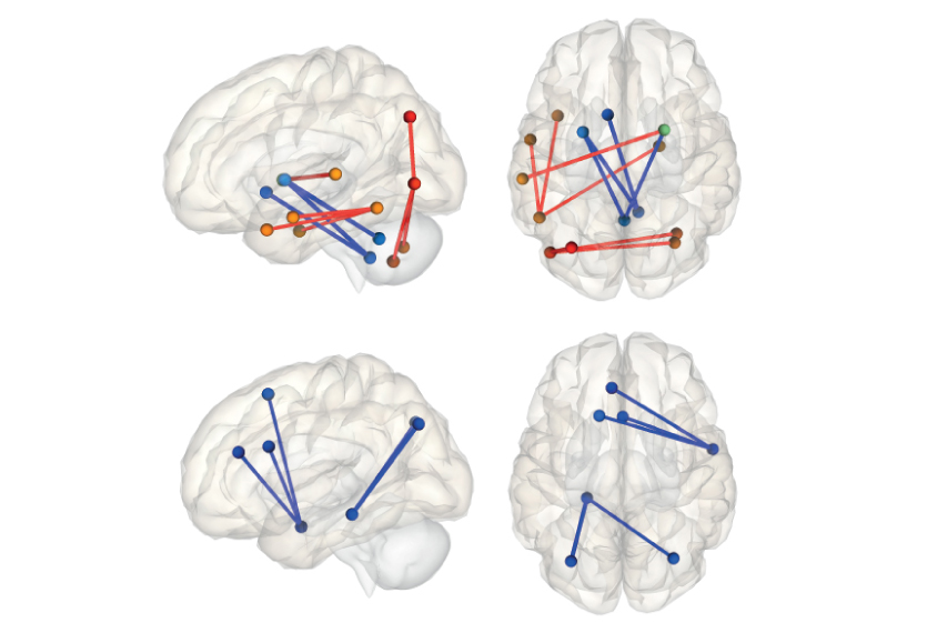 Relative to controls, children with autism taking certain drugs have greater functional connectivity between brain regions (top, red), whereas unmedicated children with autism show less connectivity (bottom, blue).