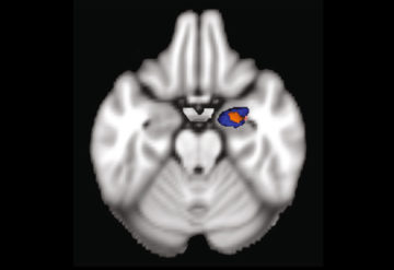 A brain scan showing an abnormally small amygdala