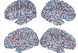 Image of brains showing The crests of the brain’s outer shell are more curved in people with autism (top) than in controls (bottom)