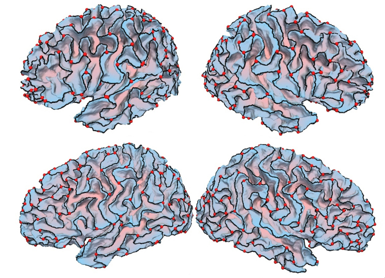 Image of brains showing The crests of the brain’s outer shell are more curved in people with autism (top) than in controls (bottom)