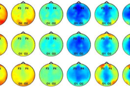 Baby sibs (top and middle rows) have weaker patterns of brain activity (blue) at the front of the brain than do controls (bottom row).
