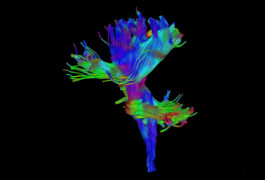 tructural images of autism brains rarely depict the brain stem.