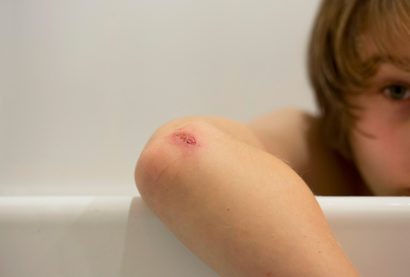 child in bathtub with a cut on elbow