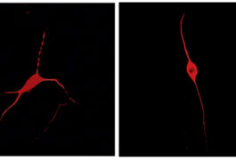 Neurons derived from people with autism make unusually few branches (right). Exposing them to control astrocytes fixes the problem (left).