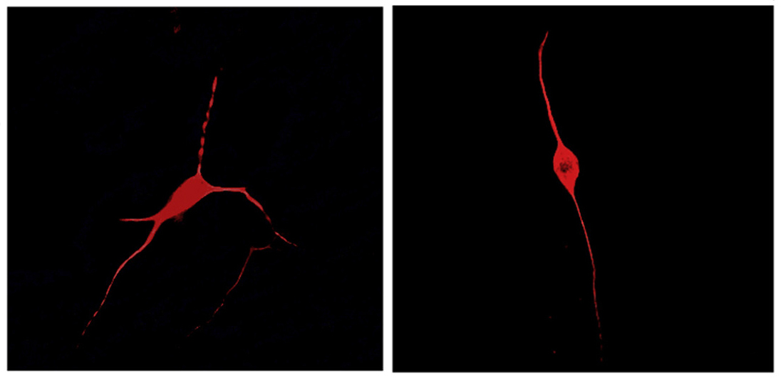 Neurons derived from people with autism make unusually few branches (right). Exposing them to control astrocytes fixes the problem (left).