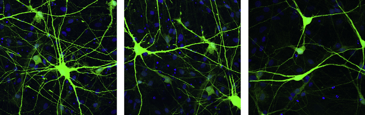 Neurons missing a part of chromosome 16 (left) are larger and have more branches than control neurons (middle); neurons with duplications of the region are small and sport short dendrites (right).