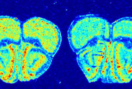 A mouse model of tuberous sclerosis (right) shows less protein synthesis in the brain than a control (left).