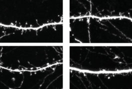 Neurons from mice missing OTUD7A (right) have fewer spines than do those from controls (left).