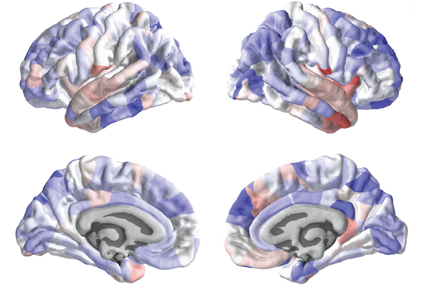 four brains sliced to show varying thickness
