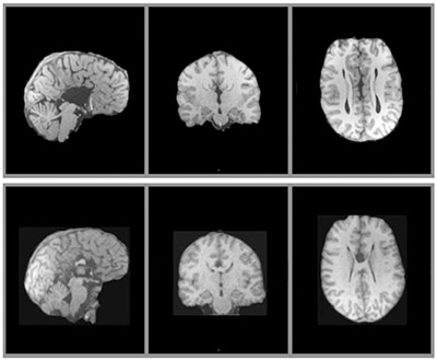 Common brain malformation confers high risk for autism | Spectrum ...